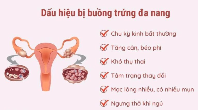 Các triệu chứng thường gặp ở buồng trứng đa nang