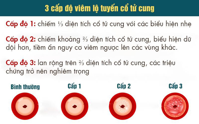 Viêm lộ tuyến cổ tử cung thường được chia làm 3 cấp độ tùy thuộc vào tình trạng nặng nhẹ.