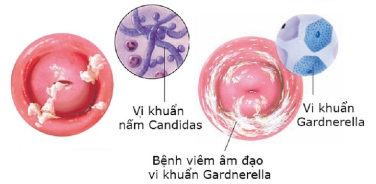 Một số nguyên nhân gây viêm âm đạo thường gặp.