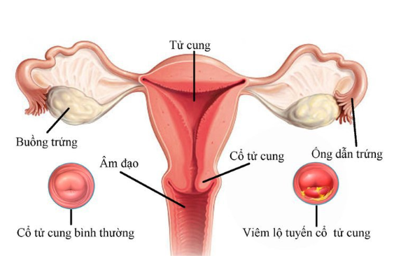 Cổ tử cung bình thường và cổ tử cung viêm lộ tuyến