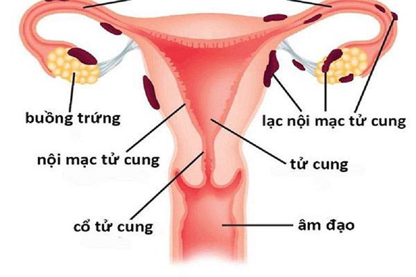 Bệnh xuất hiện ở các vị trí buồng trứng, vòi trứng, cơ tử cung.