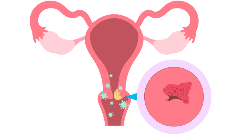 Nhiều người băn khoăn liệu người chưa quan hệ có bị nhiễm HPV hay không