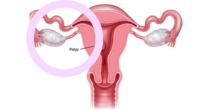 Kinh ra ồ ạt, dấu hiệu của Polyp cổ tử cung