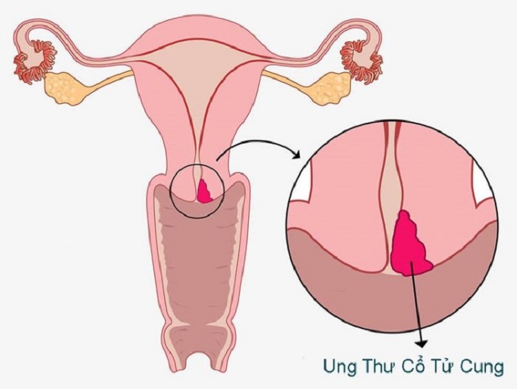 Ung thư cổ tử cung giai đoạn I (giai đoạn đầu) phản ánh mức độ phát triển của khối u