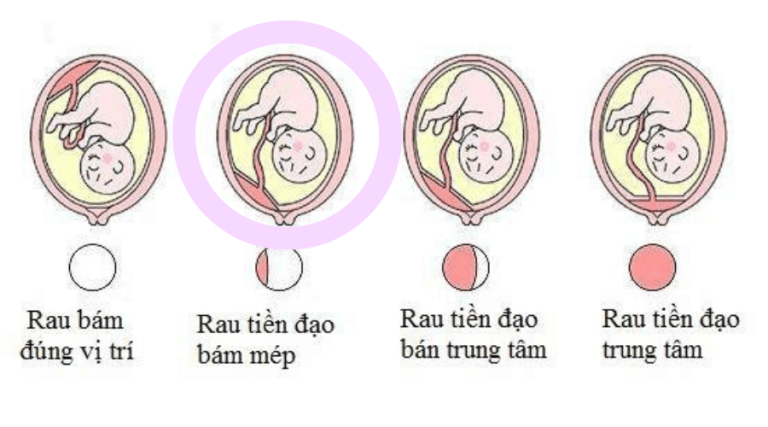 điều trị rau tiền đạo