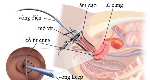 Đốt viêm lộ tuyến cổ tử cung độ 2