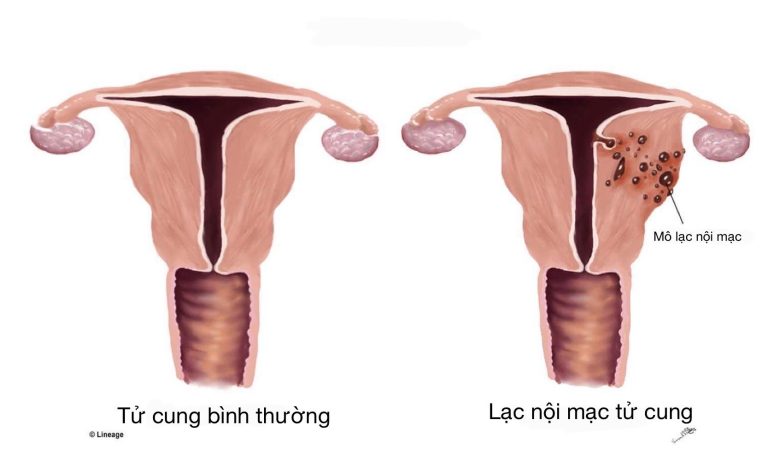 Lạc nội mạc tử cung