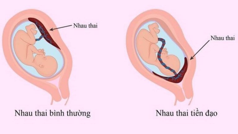 Rau tiền đạo là tình trạng rau thai có vị trí bám thấp hơn bình thường