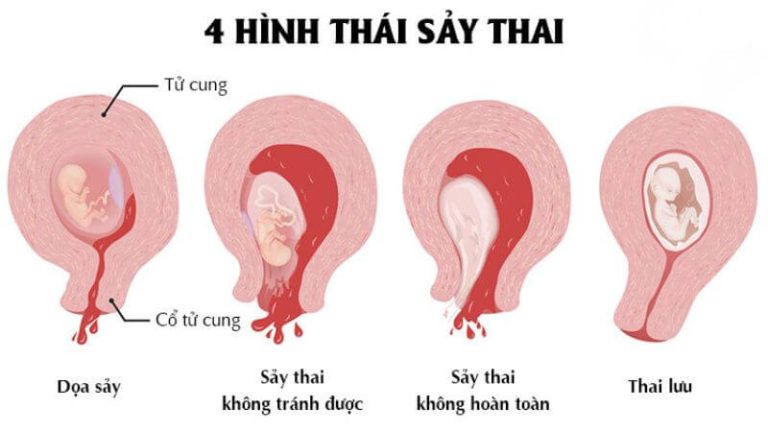 Sảy thai có nhiều hình thái khác nhau