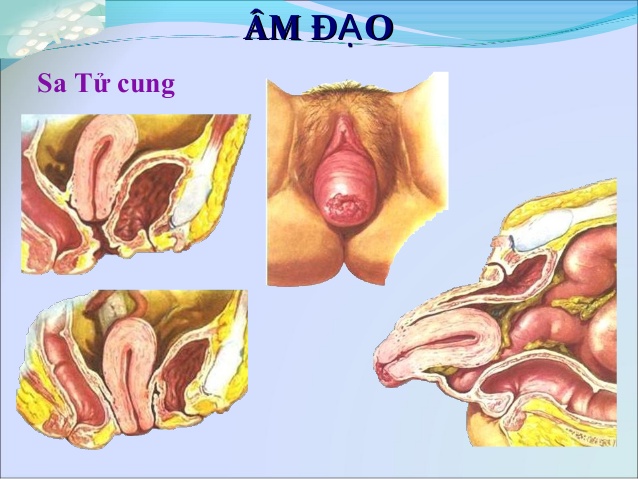 sa tử cung