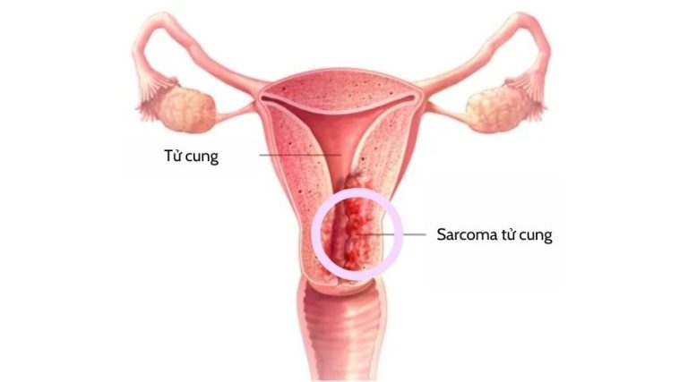 Sarcoma tử cung