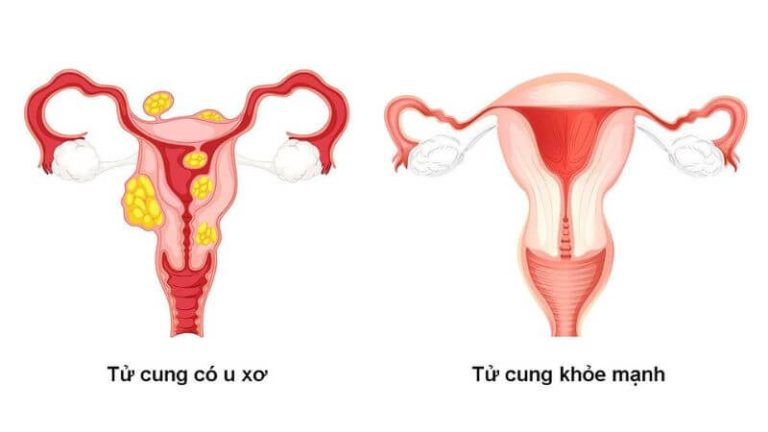 U XƠ TỬ CUNG: TRIỆU CHỨNG, NGUYÊN NHÂN, BIẾN CHỨNG, CÁCH ĐIỀU TRỊ