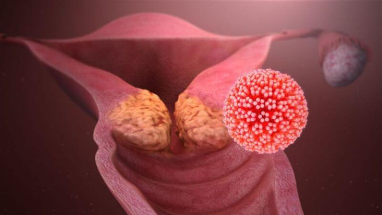 Ung thư cổ tử cung có liên quan mật thiết tới virus HPV