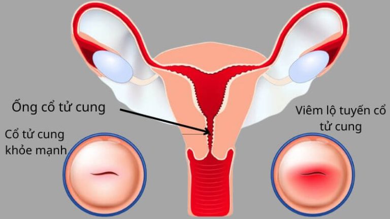 Biến chứng của viêm lộ tuyến cổ tử cung và phương pháp điều trị