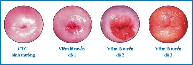 Viêm lộ tuyến cổ tử cung