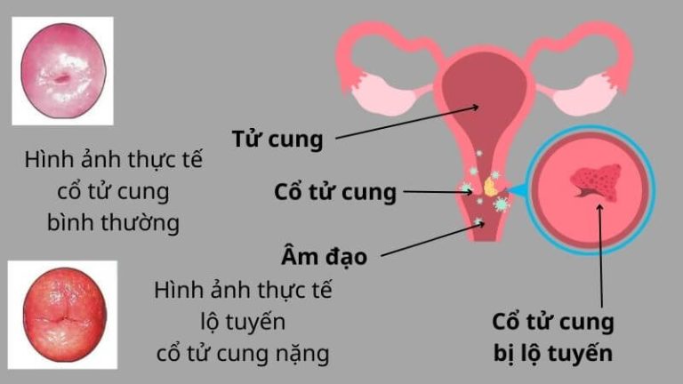 Viêm lộ tuyến cổ tử cung nặng là tình trạng lộ tuyến chiếm hơn ⅔ diện tích cổ tử cung