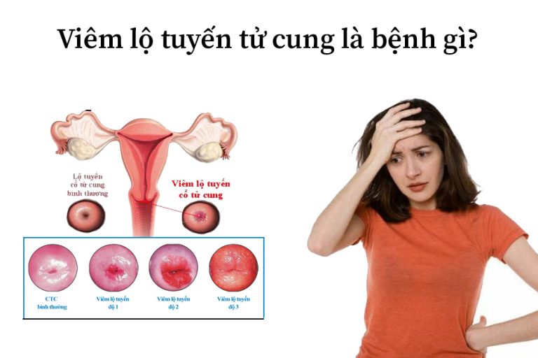 Viêm lộ tuyến cổ tử cung là một bệnh lý phụ khoa rất thường gặp ở các chị em