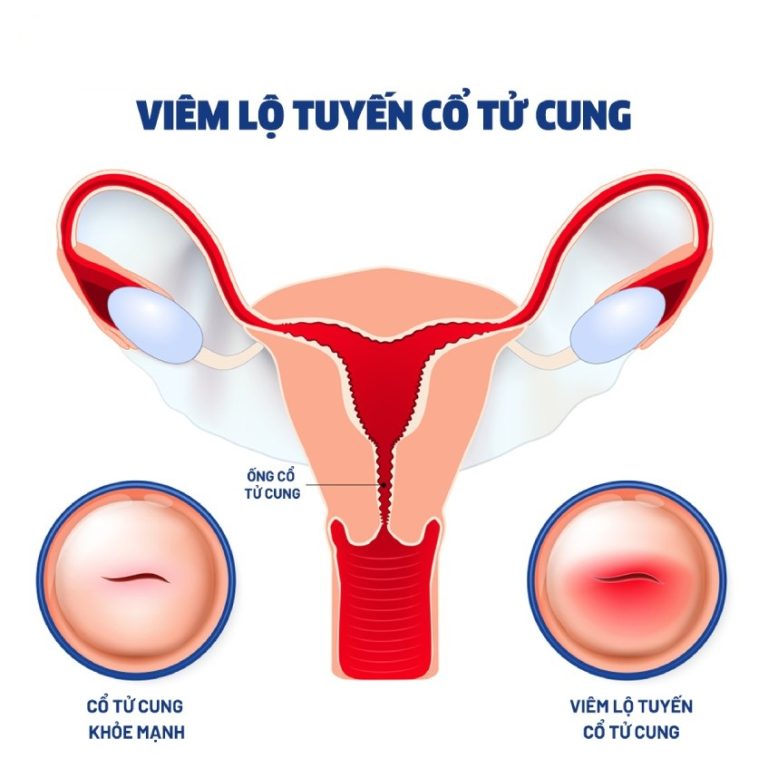 Viêm lộ tuyến cổ tử cung về cơ bản là một tổn thương lành tính của cơ thể